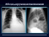 Лучевая диагностика заболеваний органов дыхания Слайд: 34