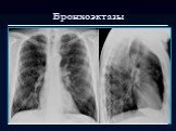 Лучевая диагностика заболеваний органов дыхания Слайд: 46