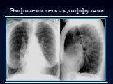 Лучевая диагностика заболеваний органов дыхания Слайд: 59