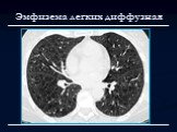Лучевая диагностика заболеваний органов дыхания Слайд: 60