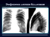 Лучевая диагностика заболеваний органов дыхания Слайд: 63