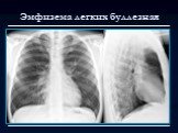 Лучевая диагностика заболеваний органов дыхания Слайд: 64