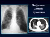 Лучевая диагностика заболеваний органов дыхания Слайд: 66
