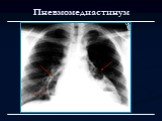 Лучевая диагностика заболеваний органов дыхания Слайд: 71