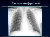Лучевая диагностика заболеваний органов дыхания Слайд: 87