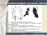 Рентгенография грудной клетки. http://urgent.mif-ua.com/archive/issue-17473/article-17483/