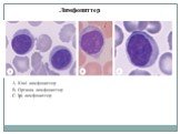 А. Кіші лимфоциттер В. Орташа лимфоциттер С. Ірі лимфоциттер