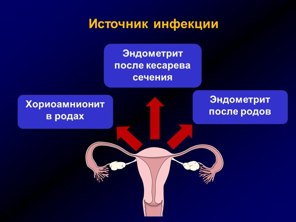 Внутреннее воспаление матки. Источники послеродовой инфекции. Пути проникновения послеродовой инфекции.