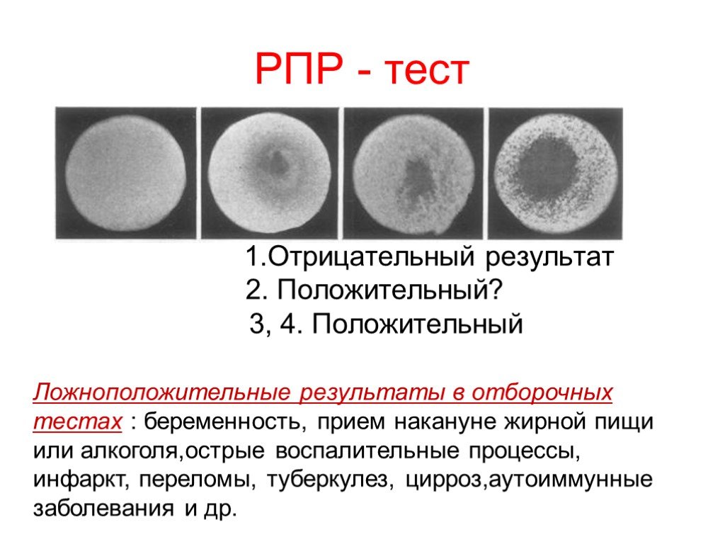 Treponema pallidum в рмп. Сифилис RPR(антикардиолипиновый тест /микрореакция преципитации), титр. Сифилис реакция микропреципитации (RPR). Syphilis RPR реакция микропреципитации с кардиолипиновым антигеном. Анализ на сифилис РПГА И ИФА.