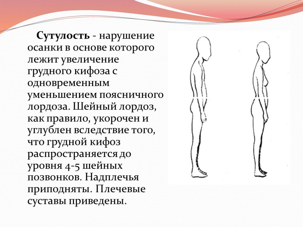 Нарушение осанки. Сутулость сколиоз осанка. Нарушение осанки круглая спина. Сутулая осанка. Нарушение осанки сутуловатость.