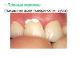 Полные коронки (покрытие всей поверхности зуба)