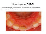 Конструкция П-П-П. Исходная ситуация – отсутствует 21 зуб, как результат травматического повреждения, 11 зуб депульпирован и изменен в цвете.
