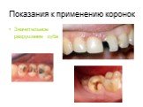 Значительное разрушение зуба