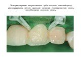 Этап реставрации искусственного зуба: построен светлый центр, реставрированы дентин, оральная основная и поверхностная эмаль, вестибулярная основная эмаль.