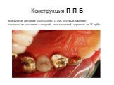 Конструкция П-П-Б. В исходной ситуации отсутствует 13 зуб, который замещен консольным протезом с опорной штампованной коронкой на 14 зубе.