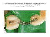 В опорных зубах зафиксирована металлическая армирующая балка с переходом из горизонтальной плоскости (14 зуба) в вертикальную (13, 12 зубов).