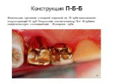 Конструкция П-Б-Б. Консольным протезом с опорной коронкой на 15 зубе восстановлен отсутствующий 14 зуб. Отсутствие контакта между 15 и 16 зубами свидетельствует о конвергенции 15 опорного зуба.