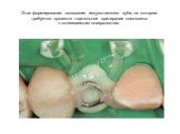 Этап формирования основания искусственного зуба, на котором требуется провести тщательное притирание композита к склеиваемым поверхностям.