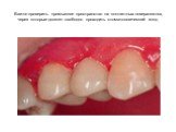 Важно проверить промывное пространство на контактных поверхностях, через которые должен свободно проходить стоматологический зонд.