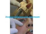 Инфраорбитальная анестезия
