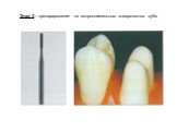 Этап 3 – препарирование на аппроксимальных поверхностях зуба