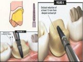Теоретические аспекты препарирования зубов под искусственные коронки Слайд: 35