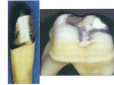 Теоретические аспекты препарирования зубов под искусственные коронки Слайд: 40
