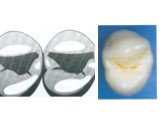 Теоретические аспекты препарирования зубов под искусственные коронки Слайд: 43