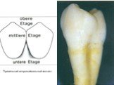 Теоретические аспекты препарирования зубов под искусственные коронки Слайд: 44