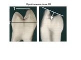 Теоретические аспекты препарирования зубов под искусственные коронки Слайд: 46