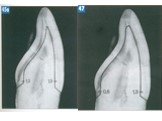 Теоретические аспекты препарирования зубов под искусственные коронки Слайд: 52