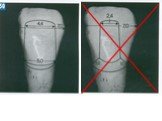 Теоретические аспекты препарирования зубов под искусственные коронки Слайд: 53