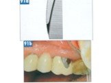 Теоретические аспекты препарирования зубов под искусственные коронки Слайд: 56