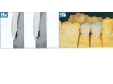 Теоретические аспекты препарирования зубов под искусственные коронки Слайд: 57