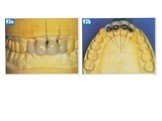Теоретические аспекты препарирования зубов под искусственные коронки Слайд: 58