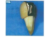 Теоретические аспекты препарирования зубов под искусственные коронки Слайд: 60