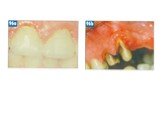 Теоретические аспекты препарирования зубов под искусственные коронки Слайд: 61