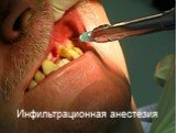 Инфильтрационная анестезия