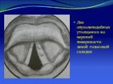Два опухолеподобных утолщения на верхней поверхности левой голосовой складки