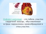 Инфаркт миокарда - это гибель участка сердечной мышцы, обусловленная острым нарушением кровообращения в этом участке.