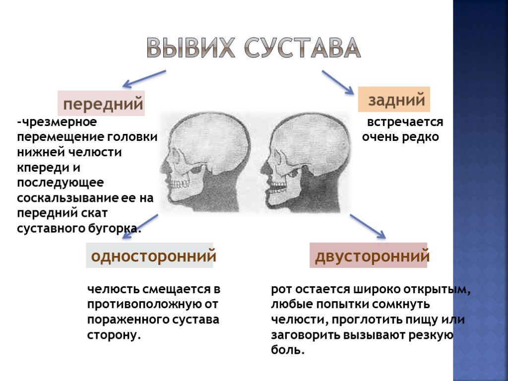 Вывих нижней челюсти презентация