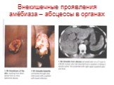 Внекишечные проявления амёбиаза – абсцессы в органах