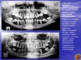 1.45, 1.47. Панорамные рентгенограммы челюстей детей с циклической и постоянной нейтропенией. Обратите внимание на равномерную атрофию кости альвеолярного отростка. Прослеживается четкая .линия атрофии. Дети в возрасте 12-14 лет, кариес зубов представлен минимально. Апикальные периодонтиты отсутству