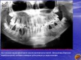 Панорамная рентгенограмма челюстей подростка, страдающего сахарным диабетом. Деструкция альвеолярной кости на всем протяжении челюстей. Деструктивный процесс неравномерный, в области некоторых зубов доходит до верхушки корня.
