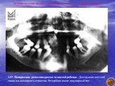 Ладонно-подошвенный дискератоз(синдром Папийон-Лефевра). 1.57. Панорамная рентгенограмма челюстей ребенка . Деструкция костной ткани альвеолярного отростка. Резорбция имеет лакунарный тип.