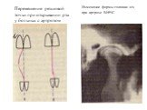 Перемещение резцовой точки при открывании рта у больных с артрозом ВНЧС. Изменение формы головки н/ч при артрозе ВНЧС