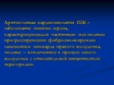 Аритмогенная кардиомиопатия ПЖ – заболевание мышцы сердца, характеризующееся частичным или полным прогрессирующим фиброзно-жировым замещением миокарда правого желудочка, позднее – вовлечением в процесс левого желудочка с относительной интактностью перегородки.