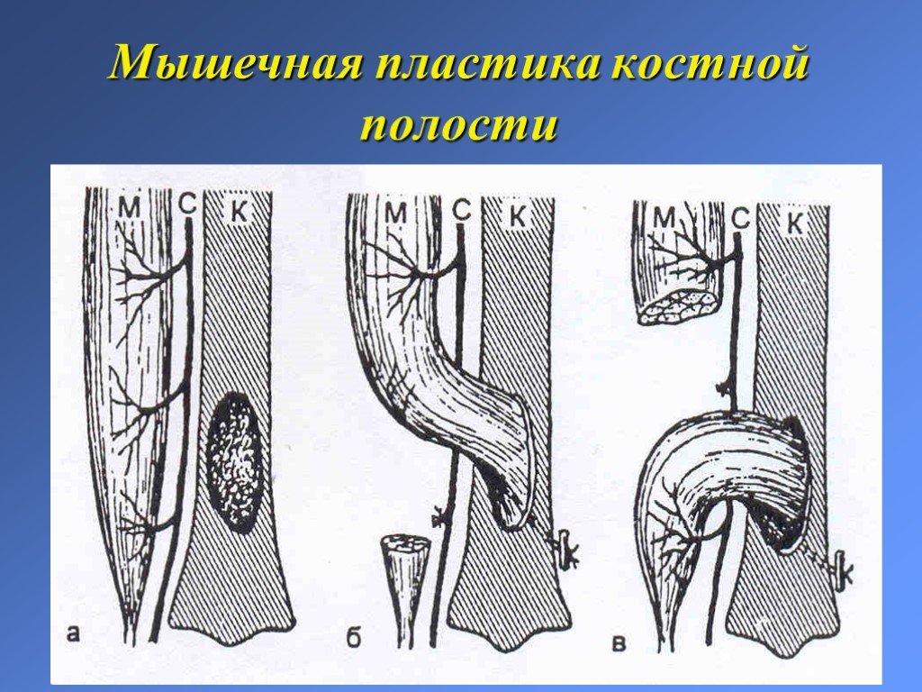 Костной полости. Мышечная пластика костной полости. Пластика костной полости мышечным лоскутом. Пластика остаточной костной полости. Сухожильно мышечная пластика.