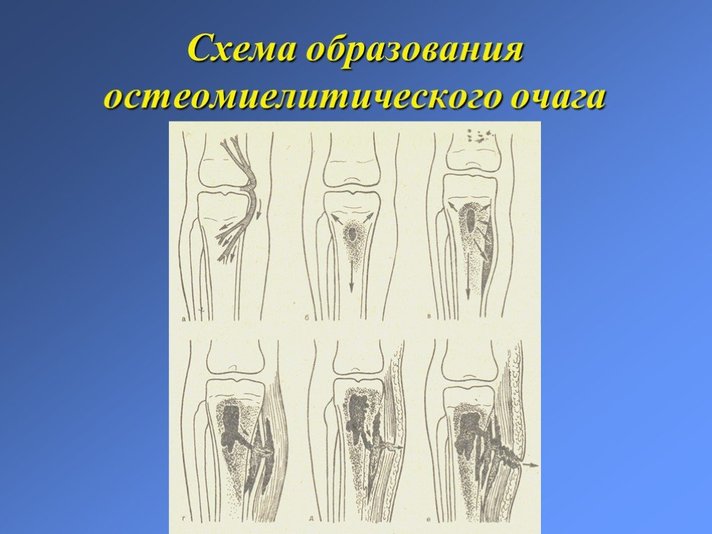 Презентация гнойные заболевания костей и суставов