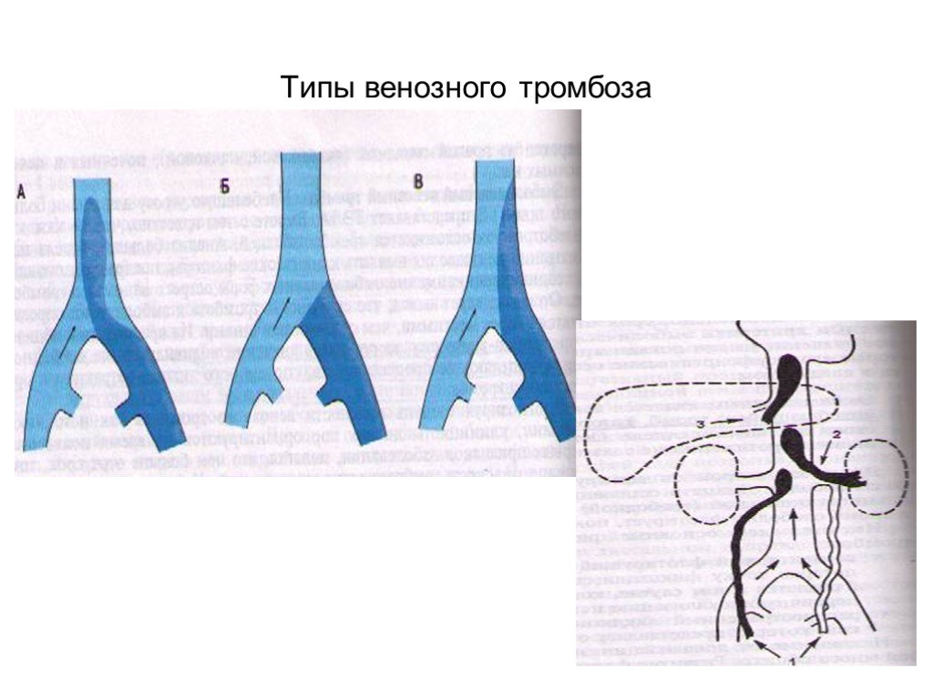 Типы тромбозов. Неокклюзирующий тромбоз. Неокклюзирующий пристеночный тромбоз.